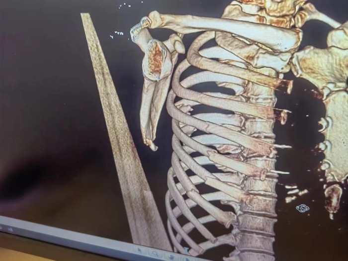 吊装钢丝绳断裂致两人坠落受伤，工人质疑绳索太细 项目回应：施工人员违规操作2