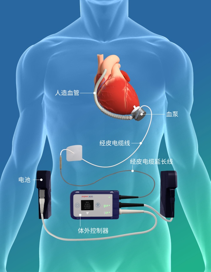 国产“磁悬浮心脏”，心衰患者的福音？4