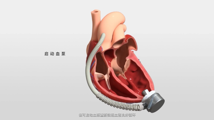 国产“磁悬浮心脏”，心衰患者的福音？3