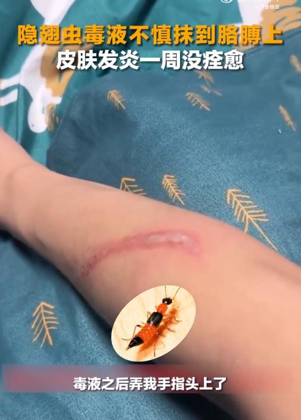 女子捏死隐翅虫手臂被腐蚀7天还没好，飞虫落在身上怎么办？1