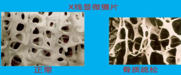 姑娘咳嗽竟咳断肋骨：过度防晒导致维生素D缺乏，骨质疏松
