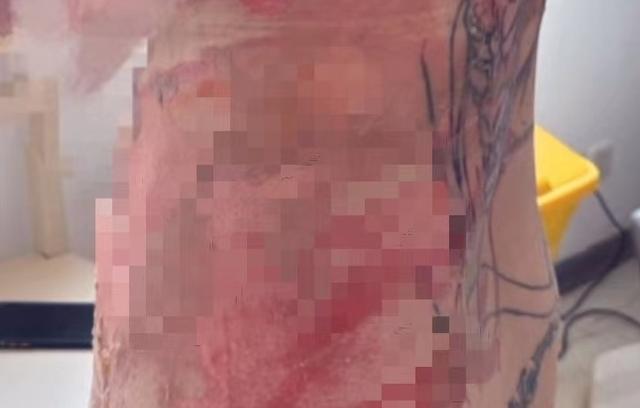 女子在上海一人气按摩店拔火罐时背部被点燃，烧伤面积达20%，其男友：需做植皮手术，在协商1