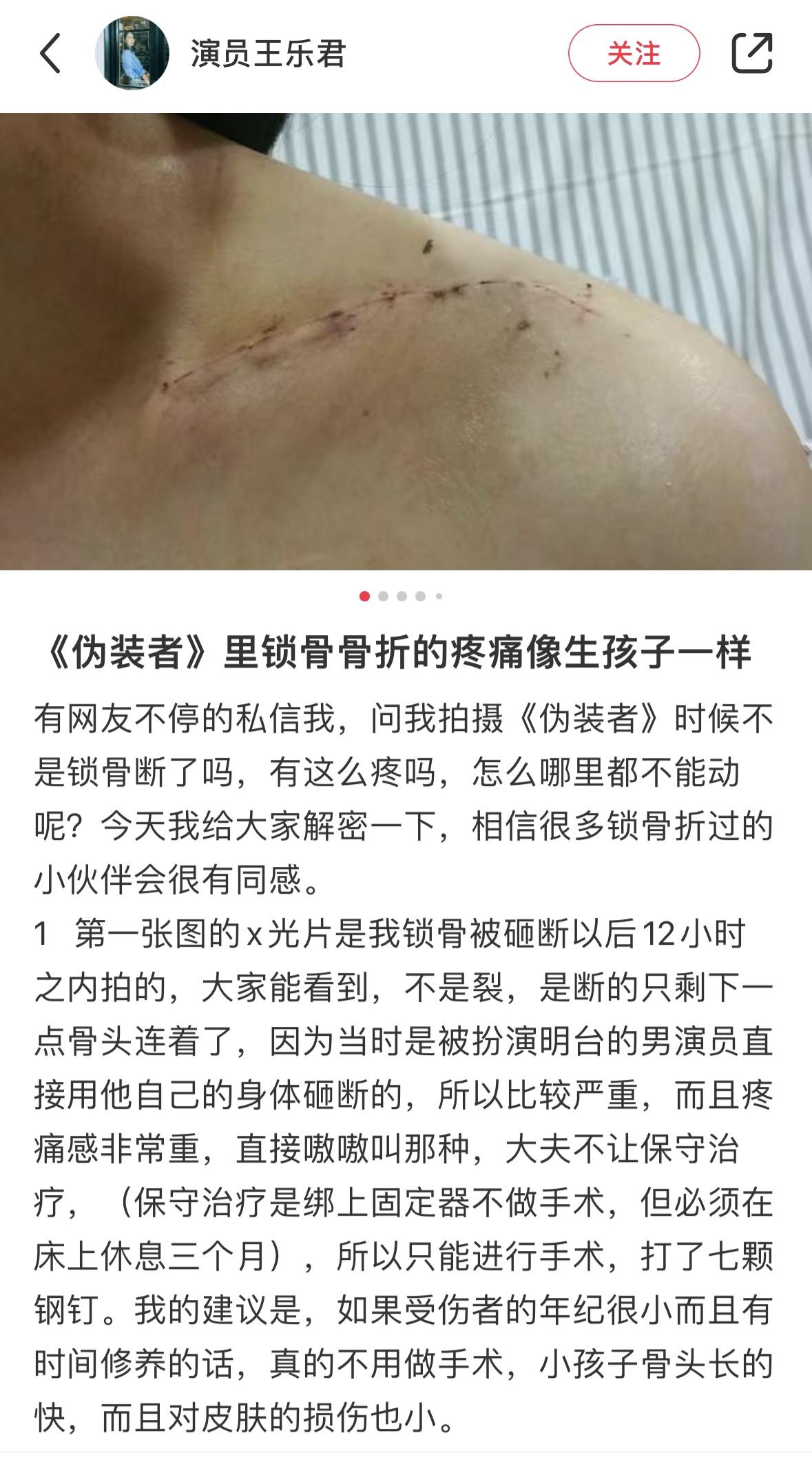 《伪装者》女演员称曾被胡歌砸断锁骨及遭胡歌粉丝谩骂