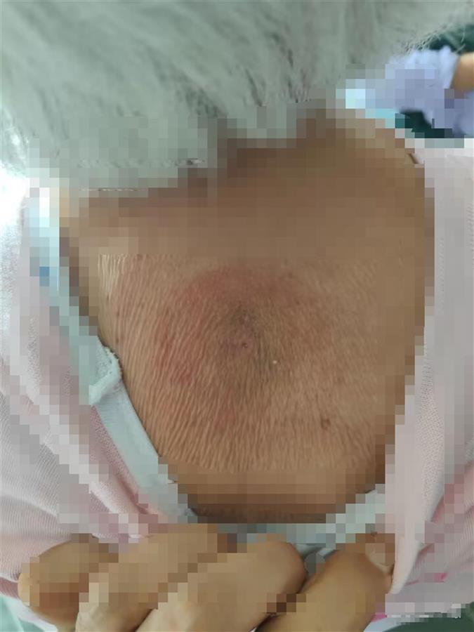 男子称母亲拔罐半小时被收费1.83万，店方：是年卡费用，已退还2