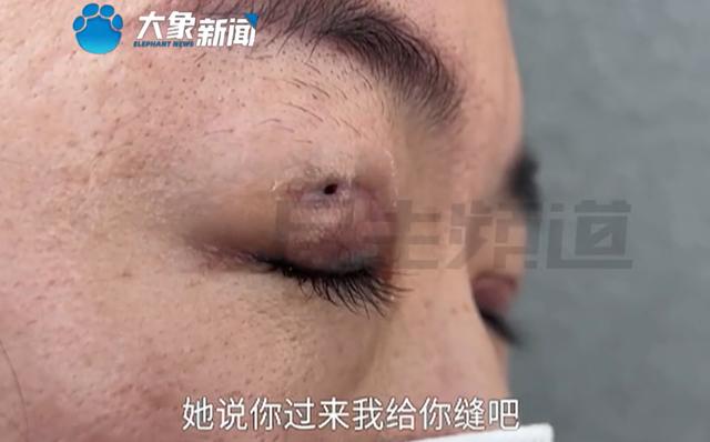 女子修复双眼皮后竟多了个洞，“闭眼能看到外面，刮风眼睛就跑风”，店方：系其本人护理不当造成3
