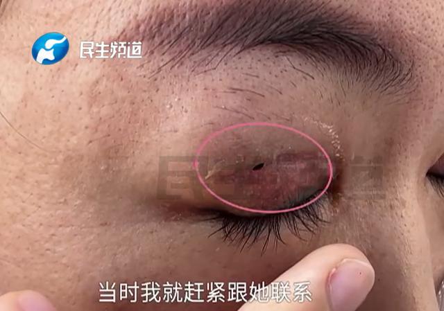 女子修复双眼皮后竟多了个洞，“闭眼能看到外面，刮风眼睛就跑风”，店方：系其本人护理不当造成2