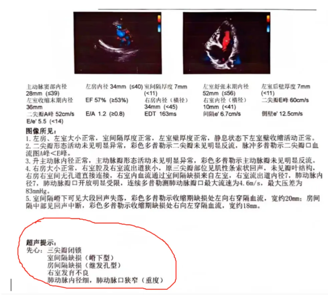 女孩身患四种先心病，却互相“修复” 心内科医生感叹：生命有时候，很神奇1