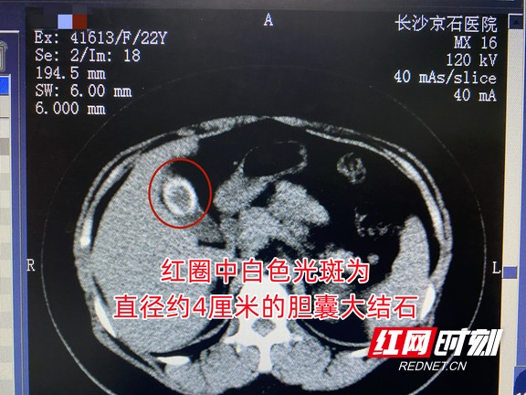 女子一天6杯咖啡还常吃零食 哪想竟惹怒鹌鹑蛋样胆囊大结石1