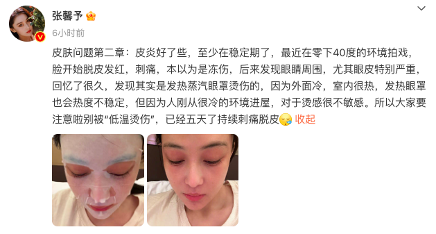 以为是冻伤结果是烫伤，张馨予拍戏遭遇“低温烫伤”2