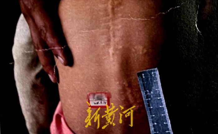 云南3岁女童被枪打伤后，与23颗弹片“共生”8年2