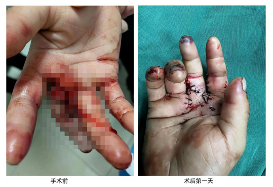 重庆医科大学附属大足医院成功开展该院首例断指再植手术
